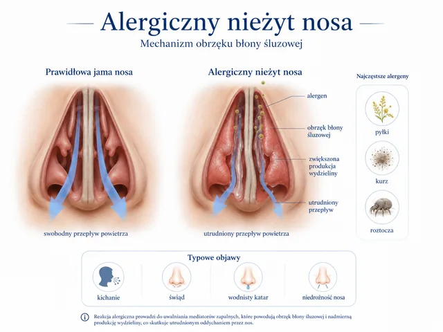 Plansza medyczna: alergiczny obrzęk błony śluzowej, alergeny, objawy i utrudniony przepływ.