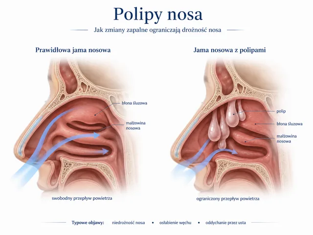 Plansza medyczna: polipy nosa i ich wpływ na ograniczenie przepływu powietrza.
