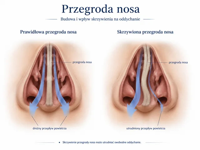 Plansza medyczna: porównanie prawidłowej i skrzywionej przegrody nosa oraz wpływu na przepływ powietrza.